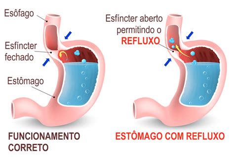 Refluxo gastroesofágico (ou RGE)